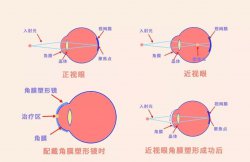 西宁爱尔：角膜塑形镜为什么可以矫正近视