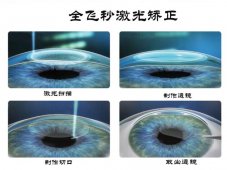 西宁爱尔：想做全飞秒需要满足这些要求