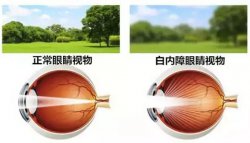 西宁爱尔：得了白内障，莫慌