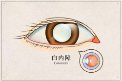 西宁爱尔：白内障的分类及检查方法有哪些