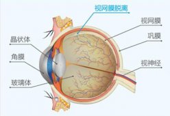 西宁爱尔眼科医院：视网膜脱落，黄金诊治期多
